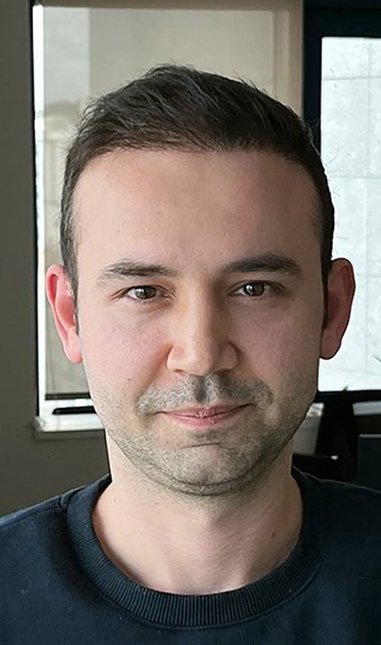Hair transplant patient 4 after