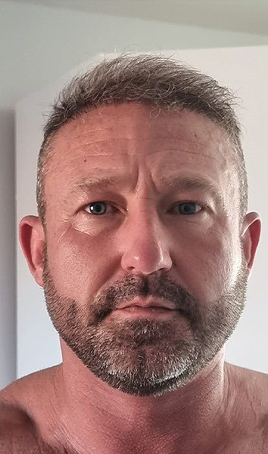Hair transplant patient 14 after