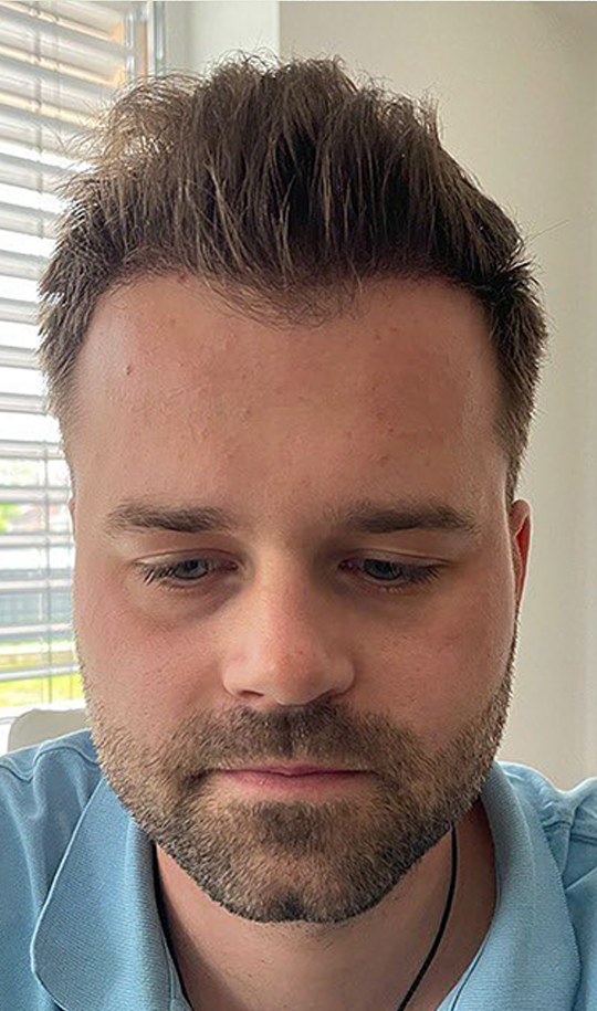 Hair transplant patient 7 after