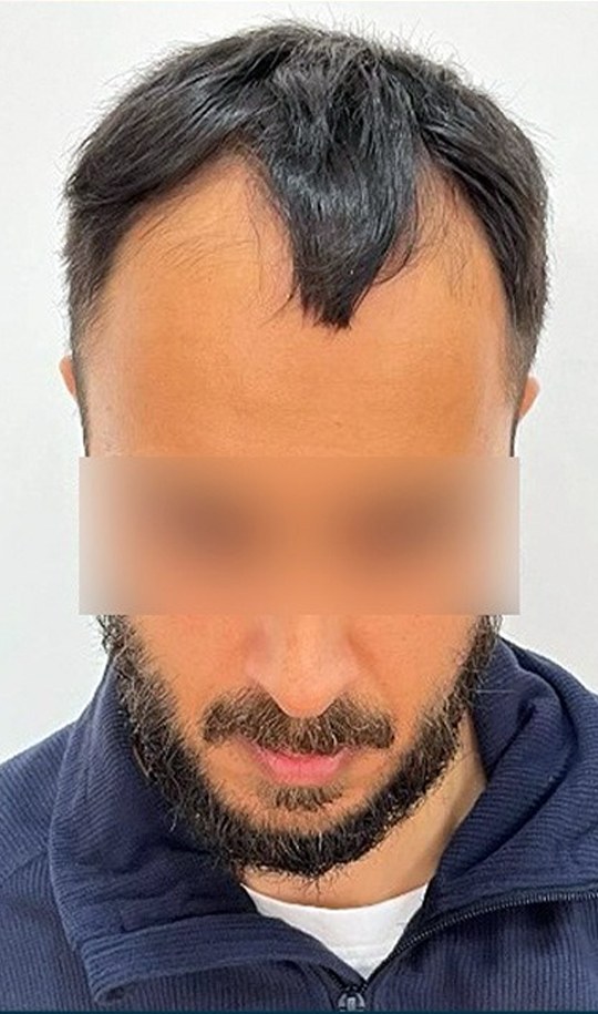 Hair transplant patient 12 before