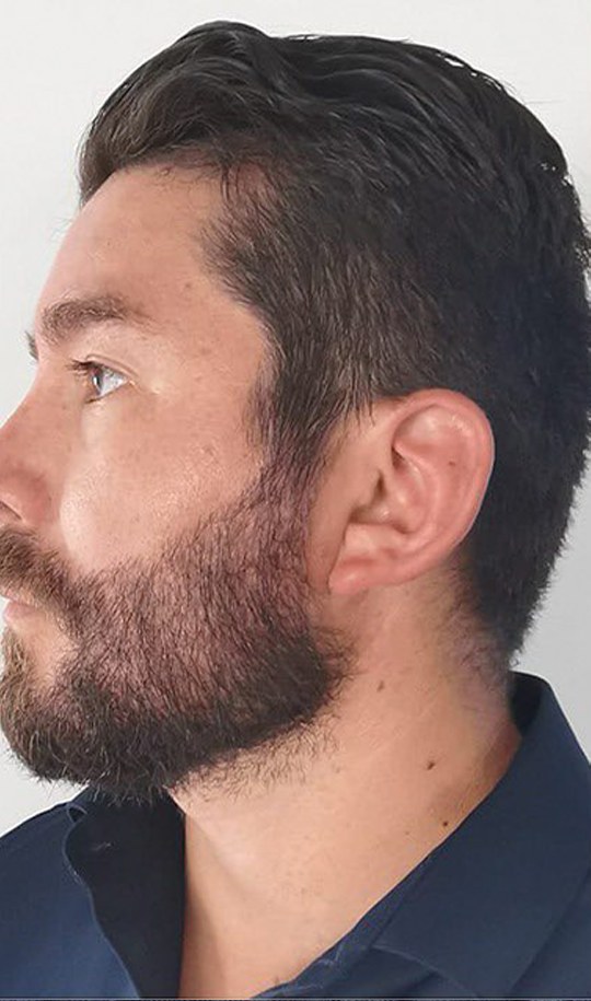 Hair transplant patient 2 after