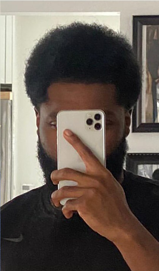 Hair transplant patient 11 after