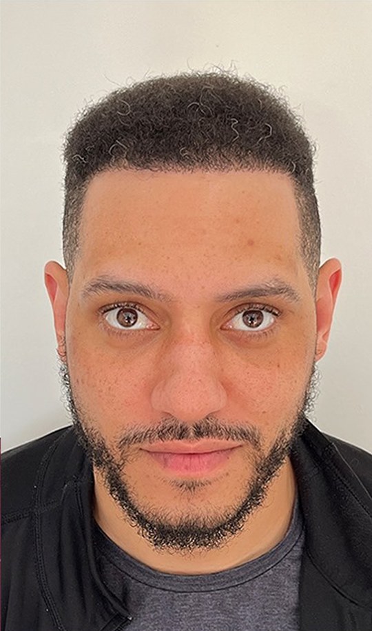 Hair transplant patient 10 after