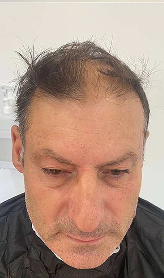 Hair transplant patient 15 before