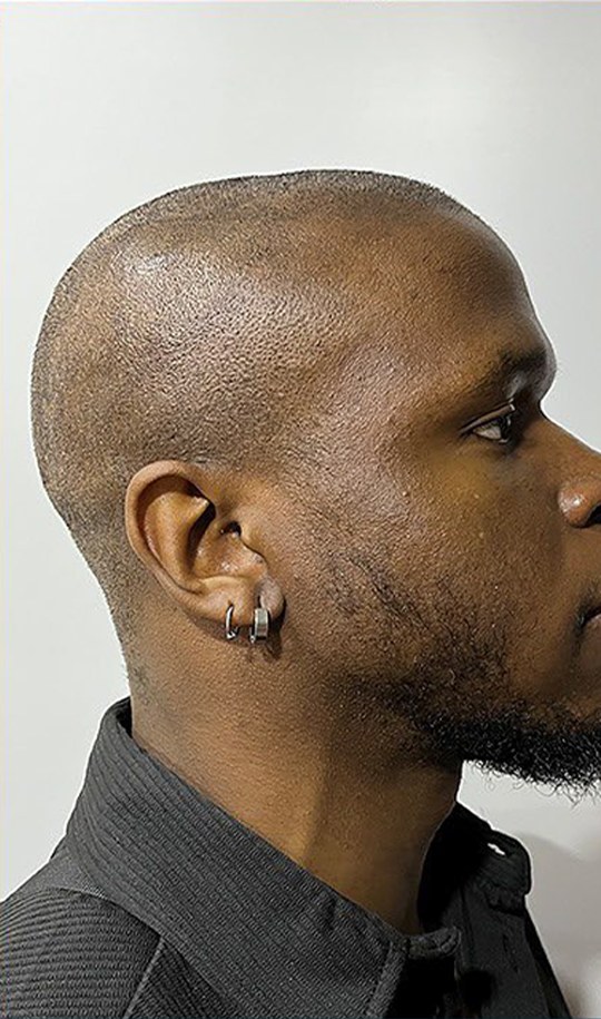 Hair transplant patient 5 before