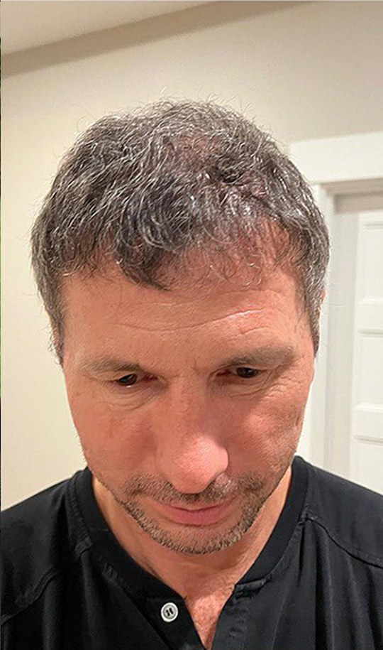 Hair transplant patient 8 after