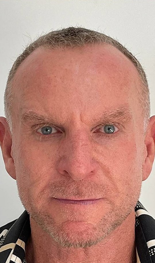 Hair transplant patient 9 before