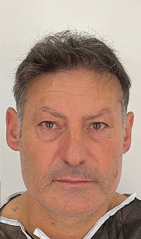 Hair transplant patient 15 after