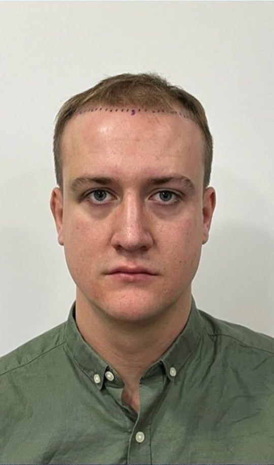 Hair transplant patient 1 before