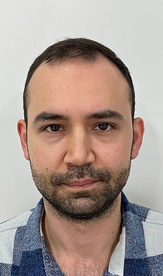Hair transplant patient 4 before