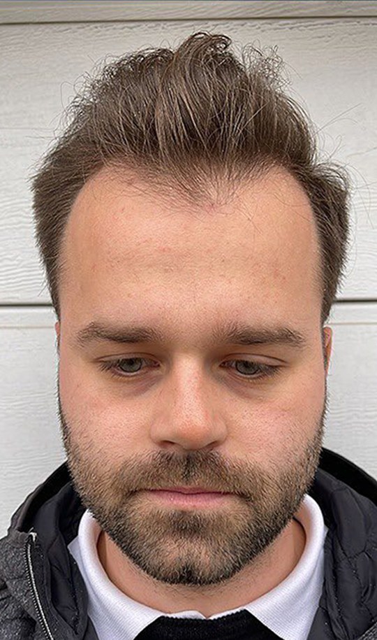 Hair transplant patient 7 before