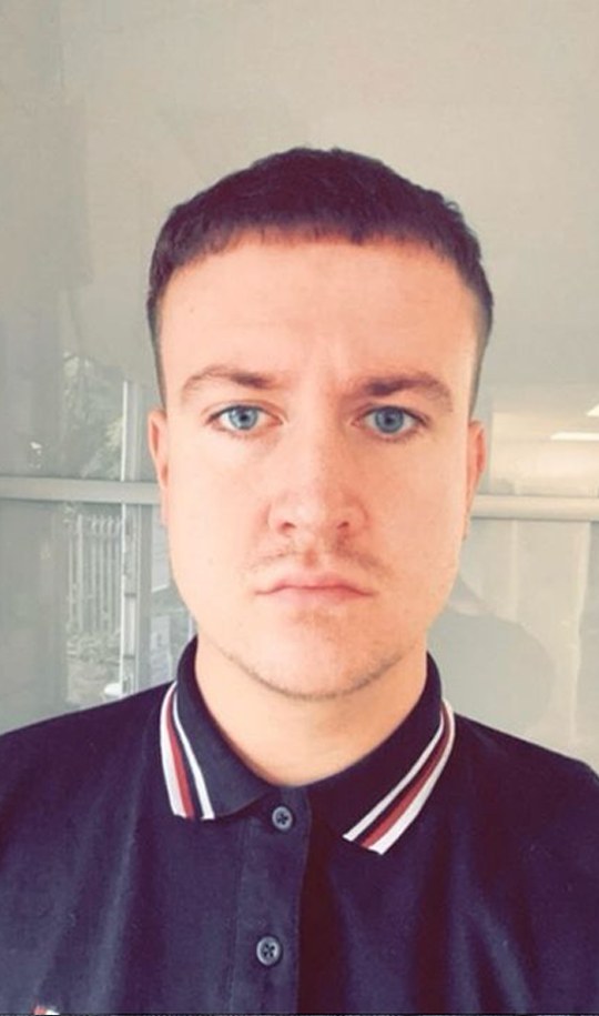 Hair transplant patient 1 after