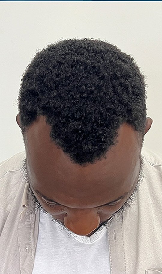 Hair transplant patient 6 before