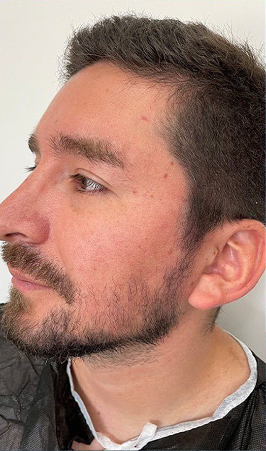 Hair transplant patient 2 before