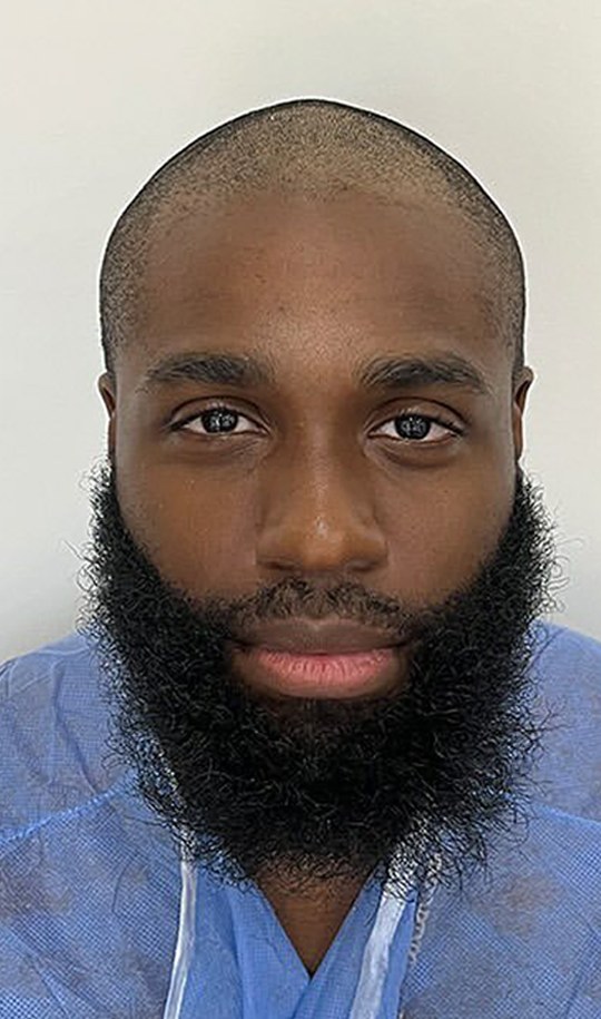 Hair transplant patient 11 before