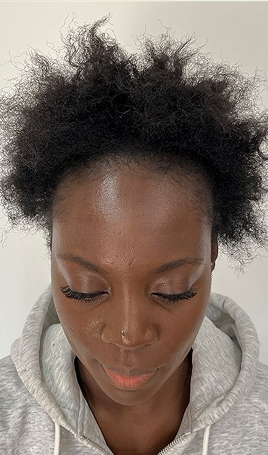 Hair transplant patient 3 before