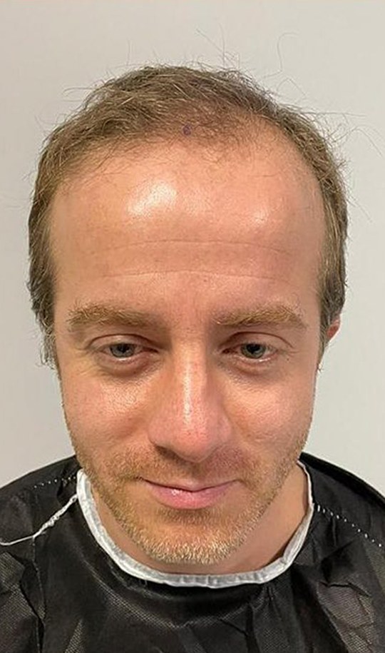 Hair transplant patient 13 before