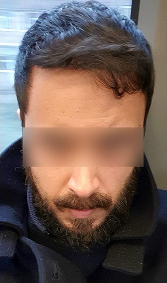 Hair transplant patient 12 after