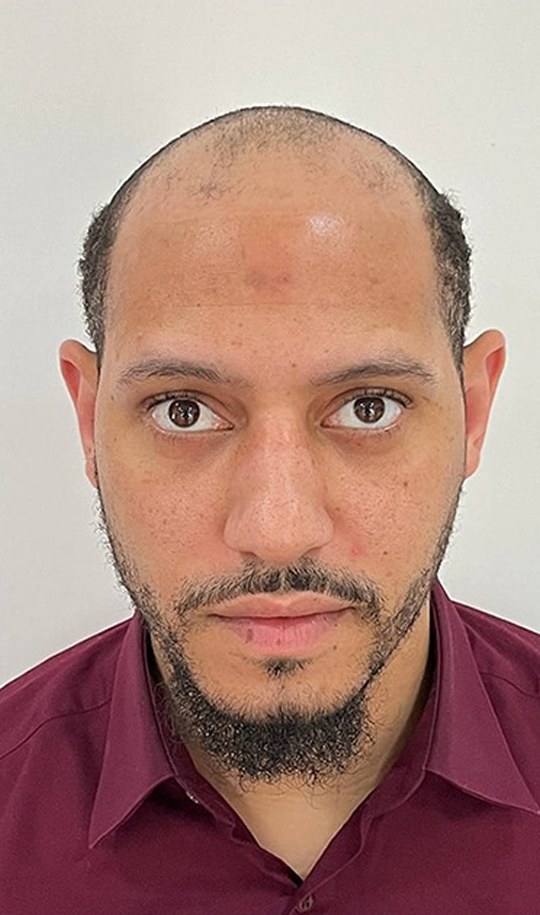 Hair transplant patient 10 before
