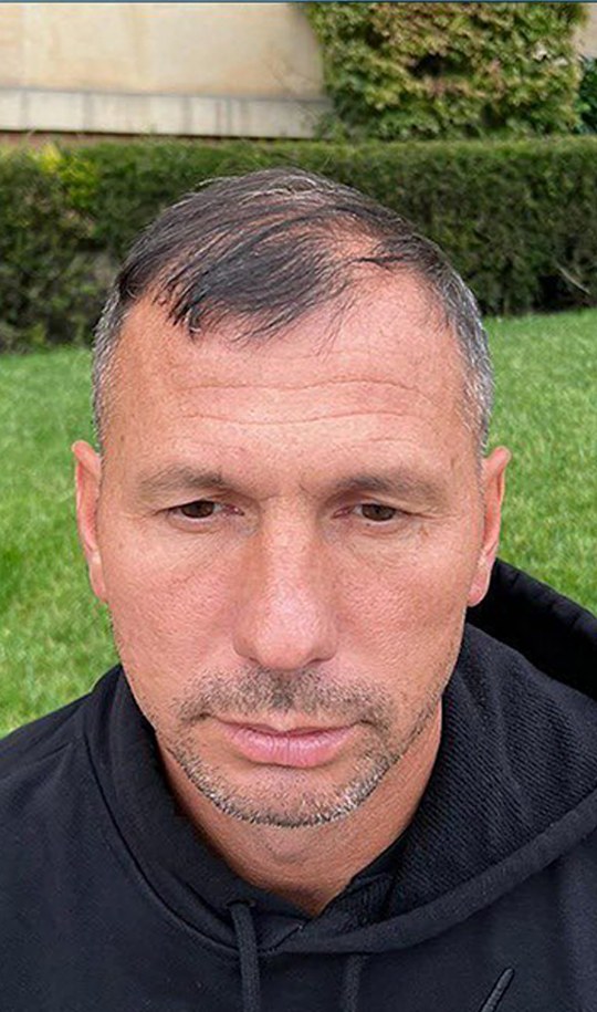 Hair transplant patient 8 before