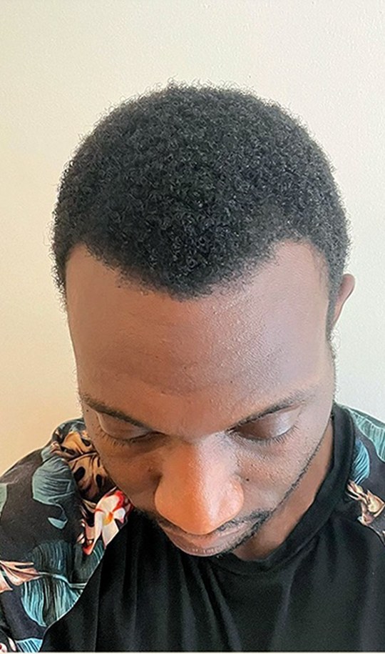 Hair transplant patient 6 after