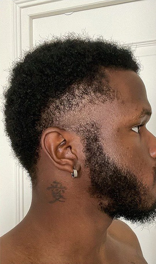 Hair transplant patient 5 after