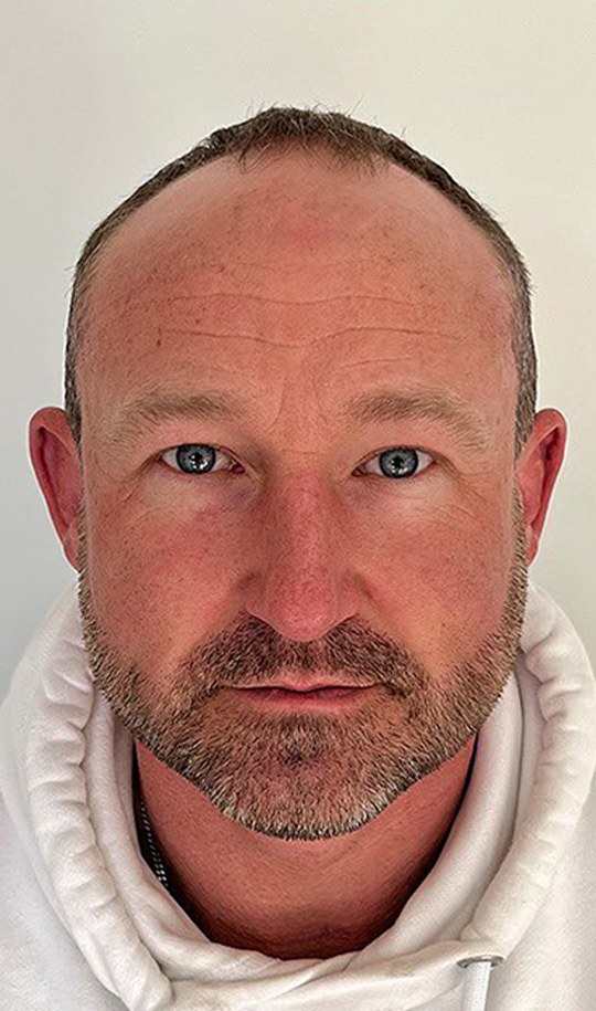 Hair transplant patient 14 before