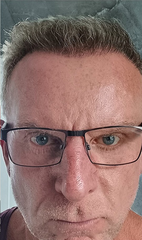 Hair transplant patient 9 after